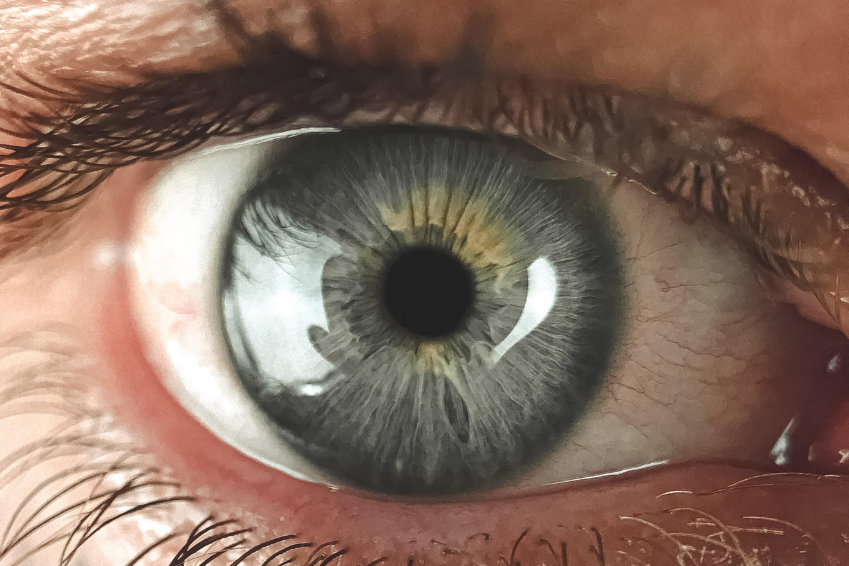 Eine abweichende Hornhautdicke kann zu einer Über- oder Unterschätzung des Augeninnendrucks führen - und damit indirekt zu einer Glaukom Ursache werden.