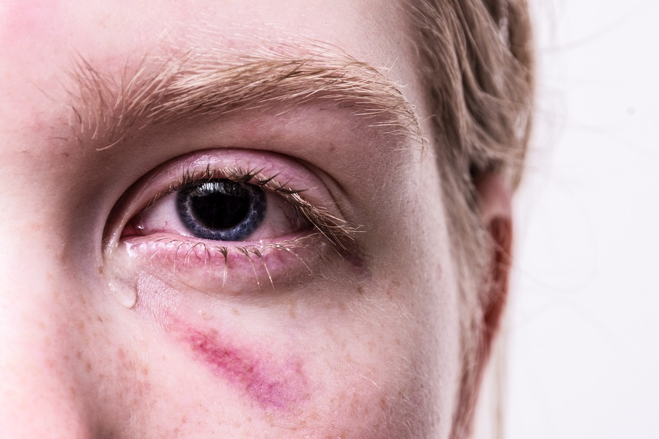 Eine direkte Verletzung des Auges kann indirekt zu einem Anstieg des Augeninnendrucks führen.