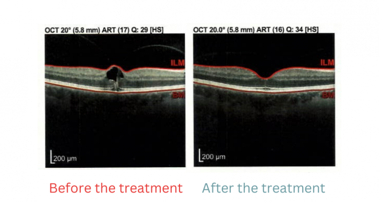 Successful treatment of macular oedema in vitreomacular traction syndrome - a patient report - Keyvisual