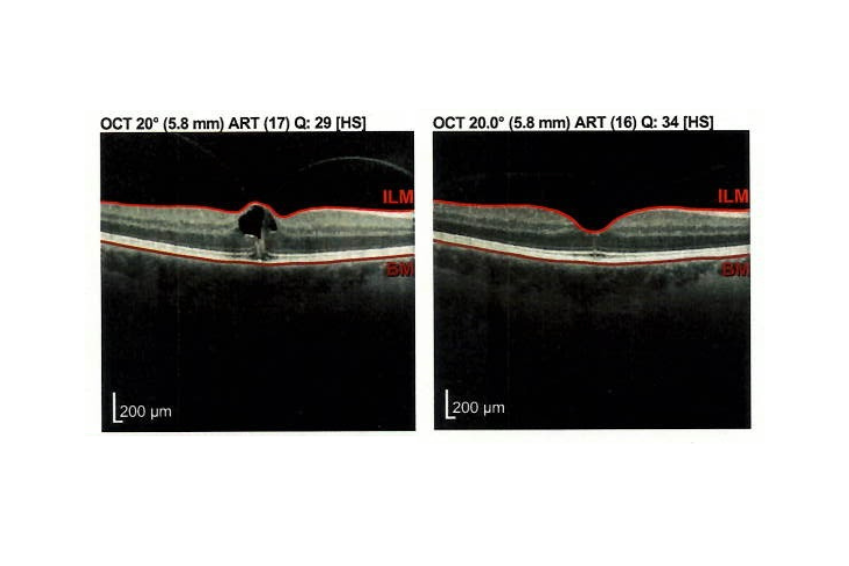 Successful treatment of macular oedema