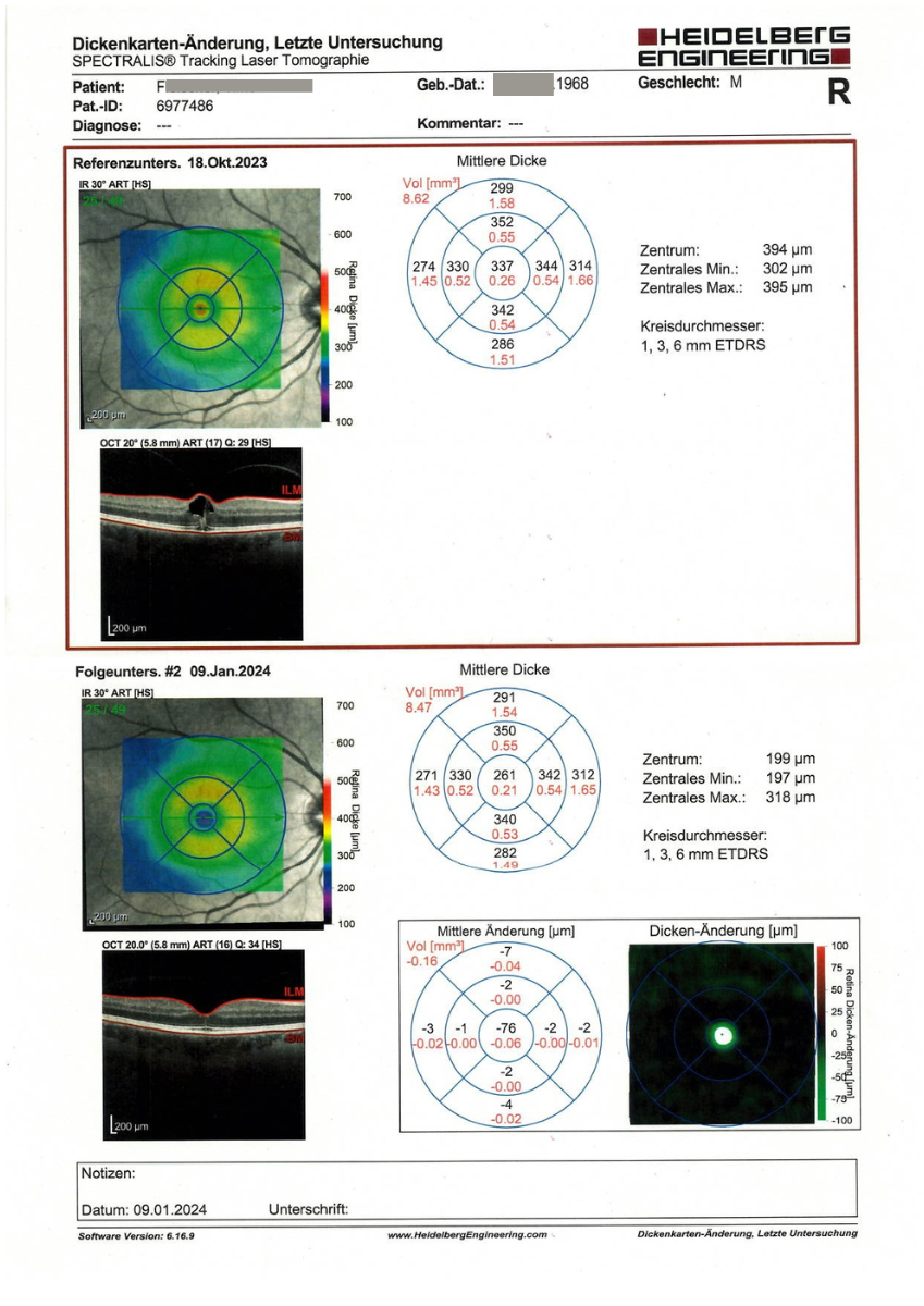 Successful treatment of macular oedema in vitreomacular traction syndrome - a patient report