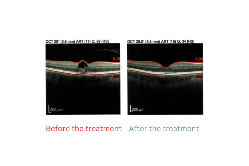 Successful treatment of macular oedema in vitreomacular traction syndrome - a patient report - Keyvisual