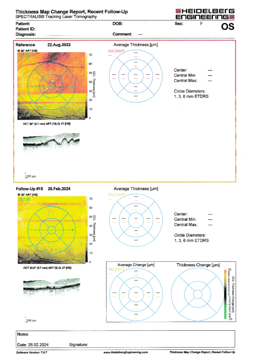 Successful treatment of wet macular degeneration - the full patient report