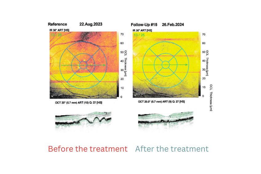 Successful treatment of dry macular degeneration - a patient report